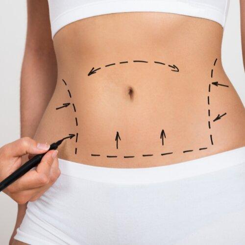Cool Sculpting (Body Contouring) Cosmetic Surgery